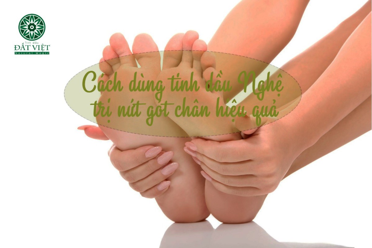 Tinh dầu Nghệ trị nứt gót chân